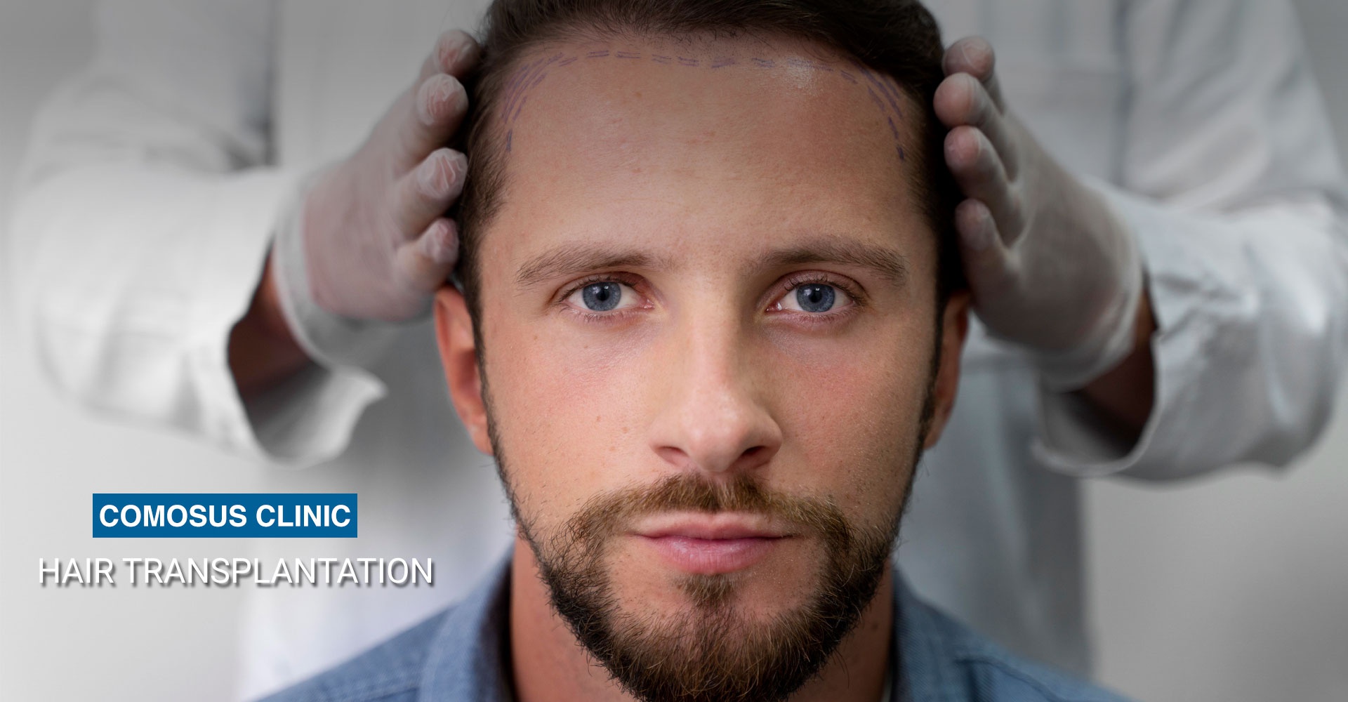 HAIR TRANSPLANTATION